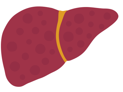 A liver with early stage liver damage or mild fibrosis