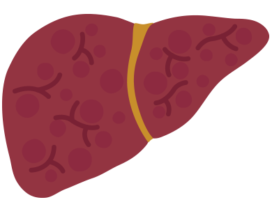 A liver with moderate fibrosis, scar tissue continues to form