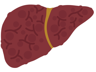 A liver with severe firbosis restricts blood flow